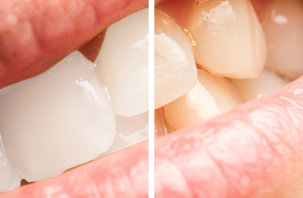 dientes blancos por resultados de estetica dental