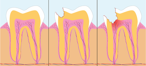infecciónpor caries en endodoncia