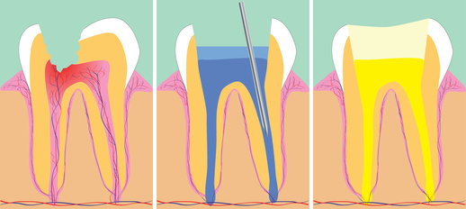 reconstruccion de diente por endodoncia