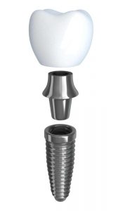 partes que componen un implante dental