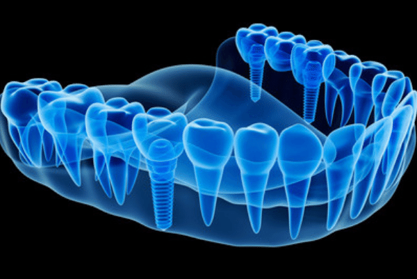 imagen en 3d de dientes con tecnologia cad-cam