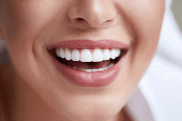 mujer con dientes blancos por blanqueamiento dental en orihuela