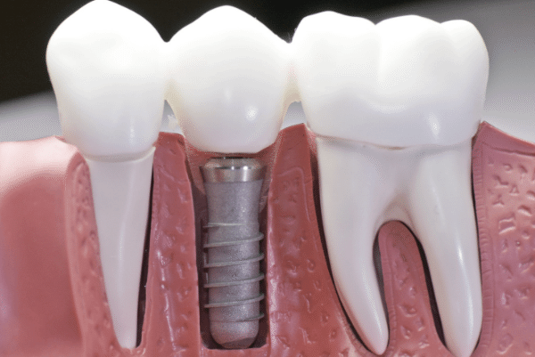 imagen explicativa de un implante dental