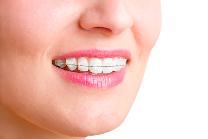 mujer sonriendo con ortodoncia