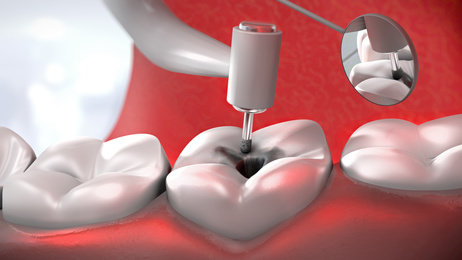 grafico de una endodoncia
